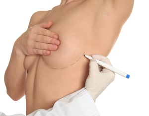 breast lift breast lift
